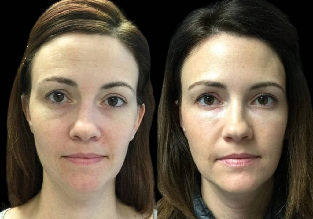 39-year-old-female-restylane-before-and-after-front-view.jpg
