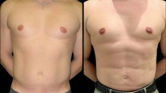 This is a 39-year-old male that has had an abdominal etching done showing the before and after's side-by-side