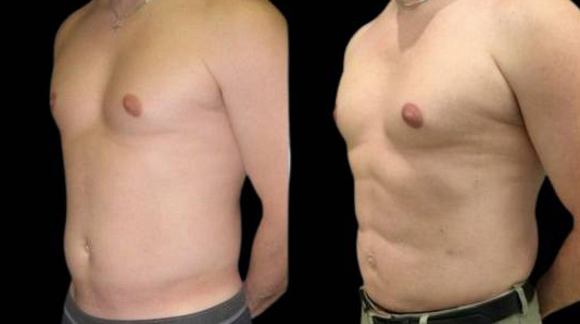 This is a 39-year-old male that has had an abdominal etching done showing the before and after's side-by-side