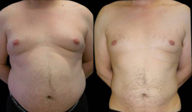 39-year-old-male-breast-reduction-before-and-after-front-view-8393.jpg
