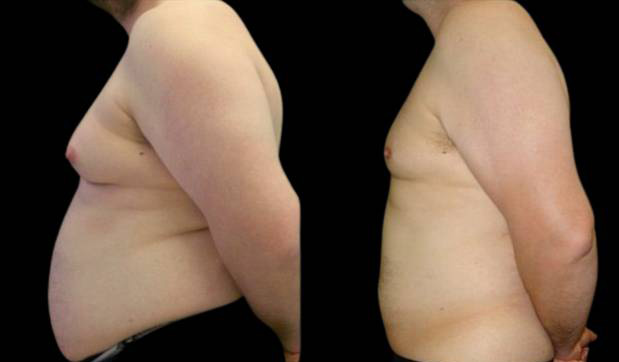 39-year-old-male-breast-reduction-before-and-after-side-view.jpg