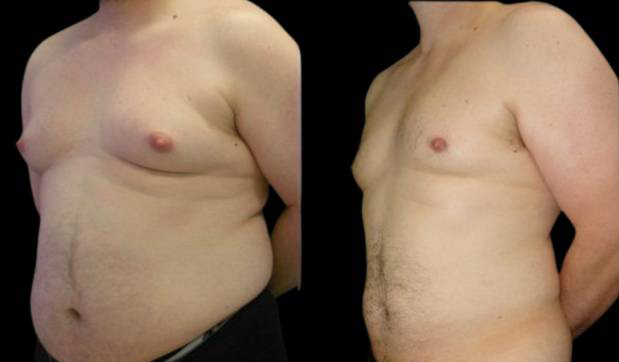 39-year-old-male-breast-reduction-before-and-after-three-quarter-view.jpg