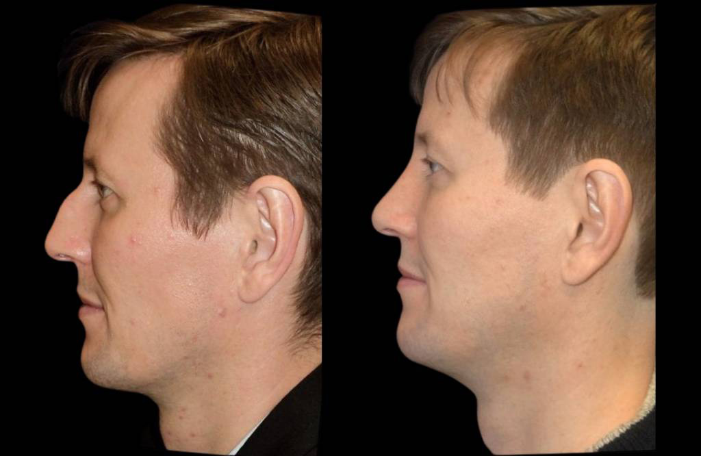 39-year-old-male-rhinoplasty-before-and-after-side-view.jpg