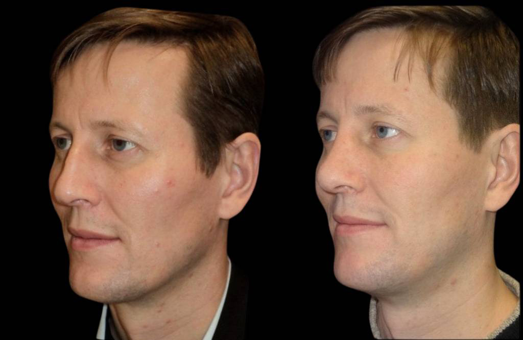 39-year-old-male-rhinoplasty-before-and-after-three-quarters-view.jpg