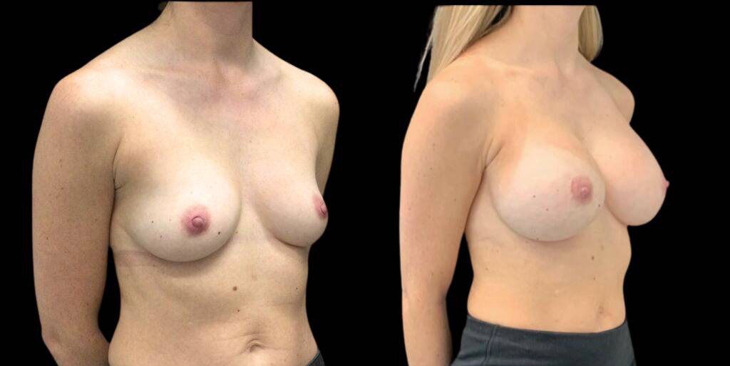 This is a 40-year-old female that has had a breast augmentation and implant showing the before and after's side-by-side