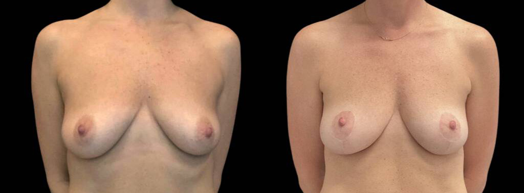 This is a 40-year-old female that has had a breast lift showing the before and after's side-by-side