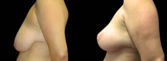 40-year-old-female-breast-lift-before-and-after-side-view-2.jpg