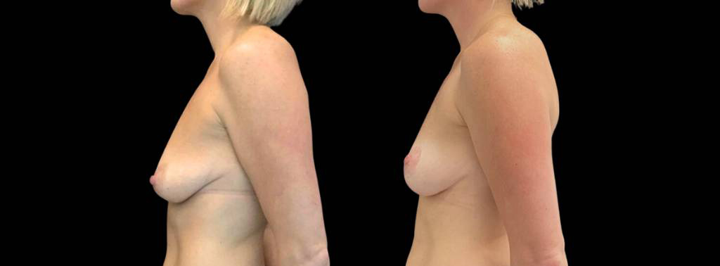 This is a 40-year-old female that has had a breast lift showing the before and after's side-by-side