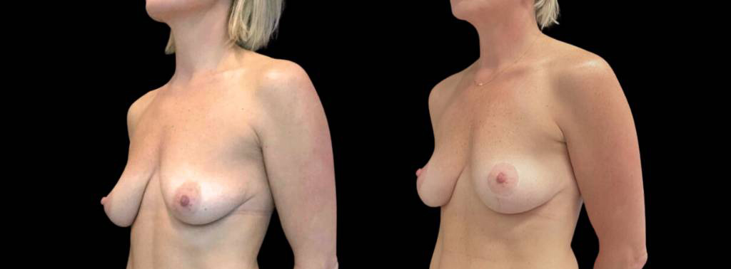 40-year-old-female-breast-lift-before-and-after-three-quarter-view.jpg