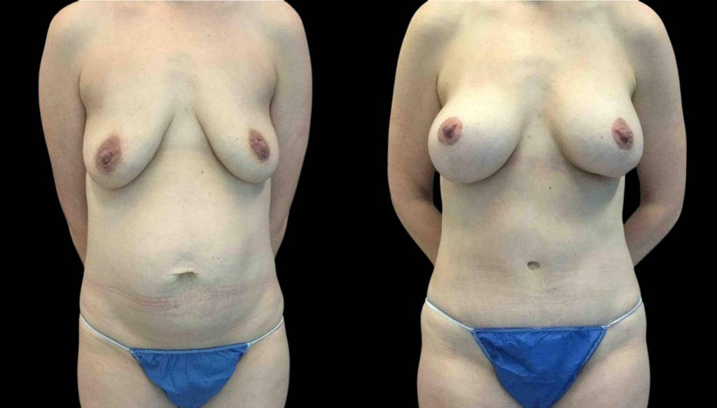 40-year-old-female-breast-lift-with-augmentation-before-and-after-front-view.jpg