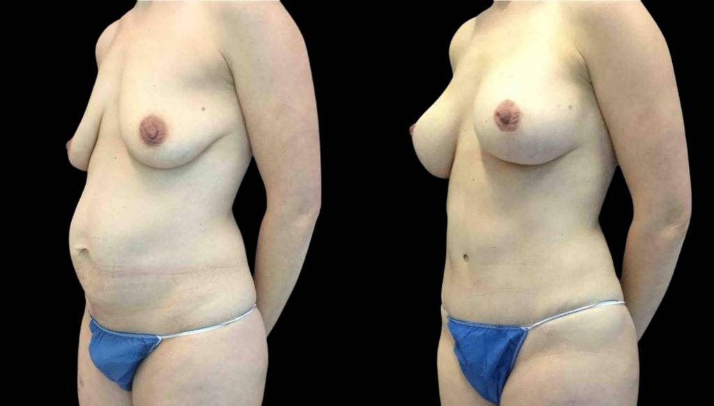 40-year-old-female-breast-lift-with-augmentation-before-and-after-three-quarter-view.jpg
