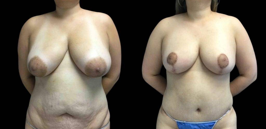 40-year-old-female-breast-reduction-before-and-after-front-view-27732.jpg