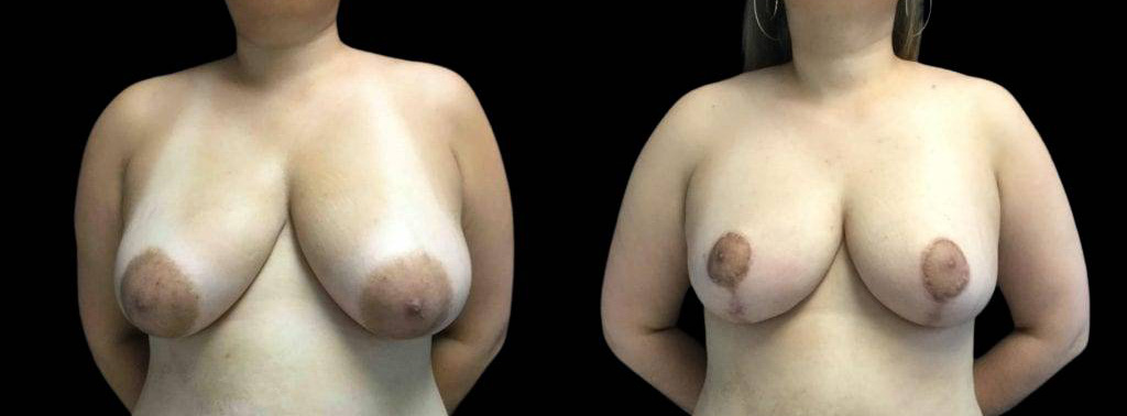 This is a 40-year-old female that has had breast reduction showing the before and after's side-by-side