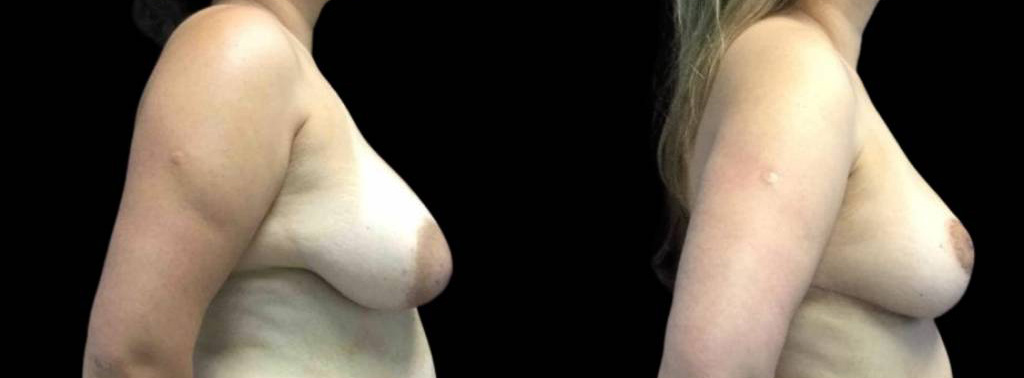 This is a 40-year-old female that has had breast reduction showing the before and after's side-by-side