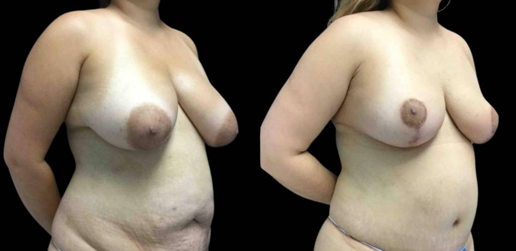 40-year-old-female-breast-reduction-before-and-after-three-quarter-view.jpg
