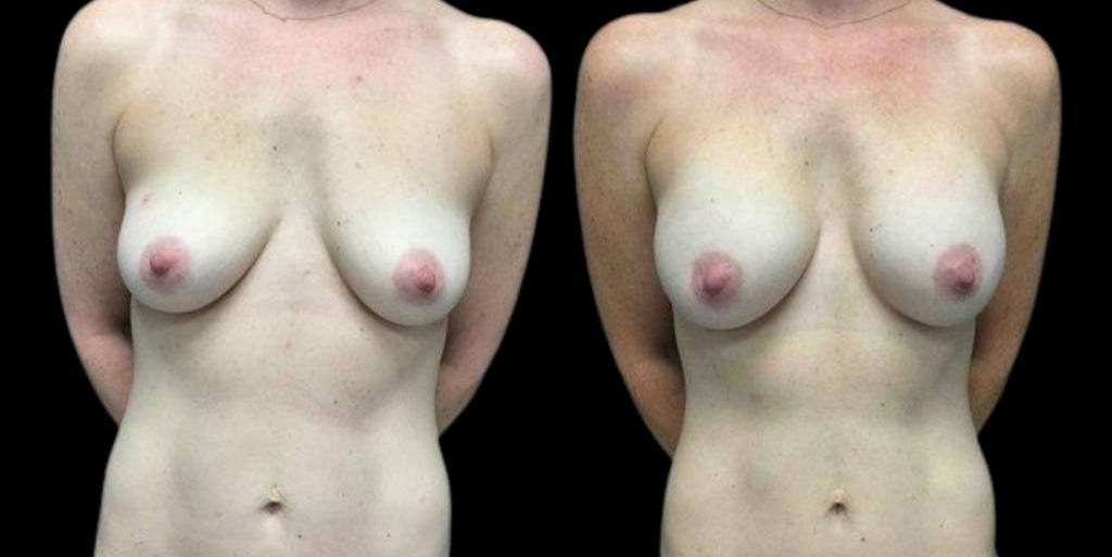 This is a 40-year-old female that has had a mommy makeover showing the before and after's side-by-side