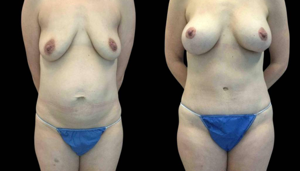 40-year-old-female-mommy-makeover-body-before-and-after-front-view-26435.jpg