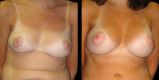 This is a 40-year-old female that has had a mommy makeover showing the before and after's side-by-side