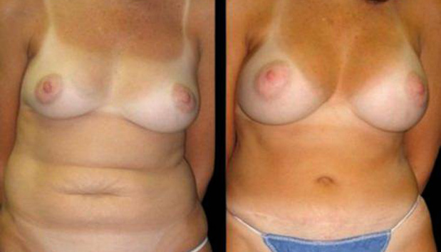 40-year-old-female-mommy-makeover-body-before-and-after-front-view-4527.jpg