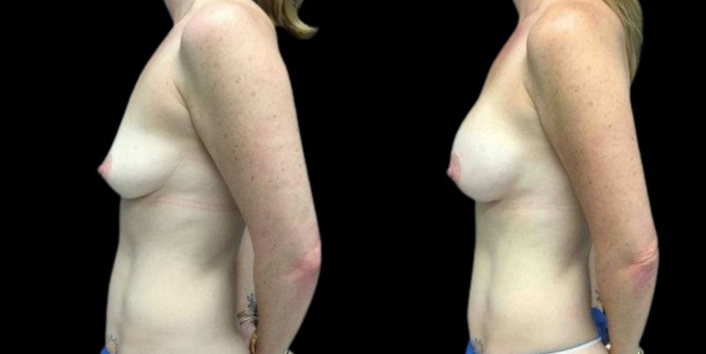 This is a 40-year-old female that has had a mommy makeover showing the before and after's side-by-side