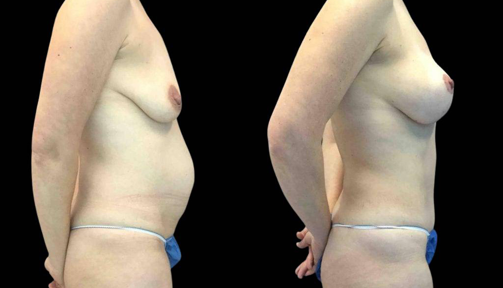 40-year-old-female-mommy-makeover-body-before-and-after-side-view-1.jpg