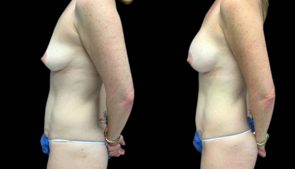 40-year-old-female-mommy-makeover-body-before-and-after-side-view.jpg