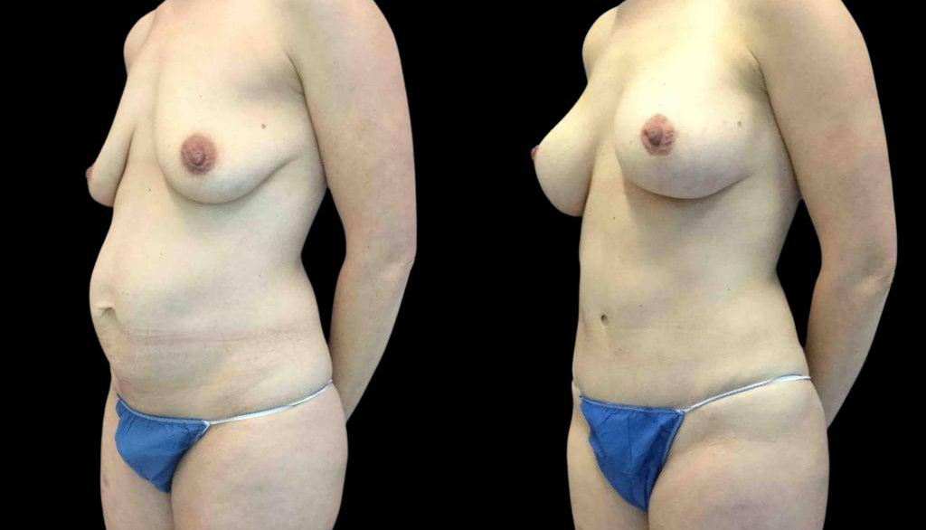 40-year-old-female-mommy-makeover-body-before-and-after-three-quarters-view-1.jpg