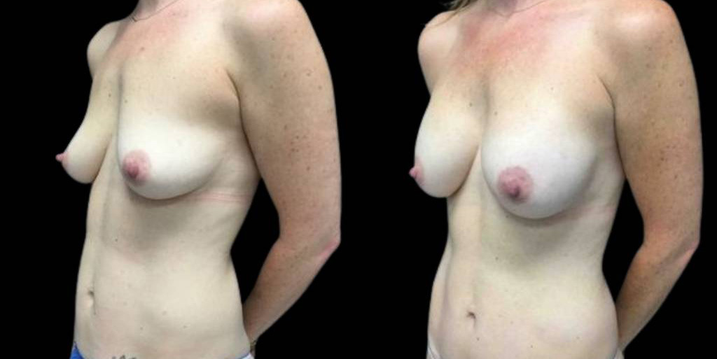 This is a 40-year-old female that has had a mommy makeover showing the before and after's side-by-side