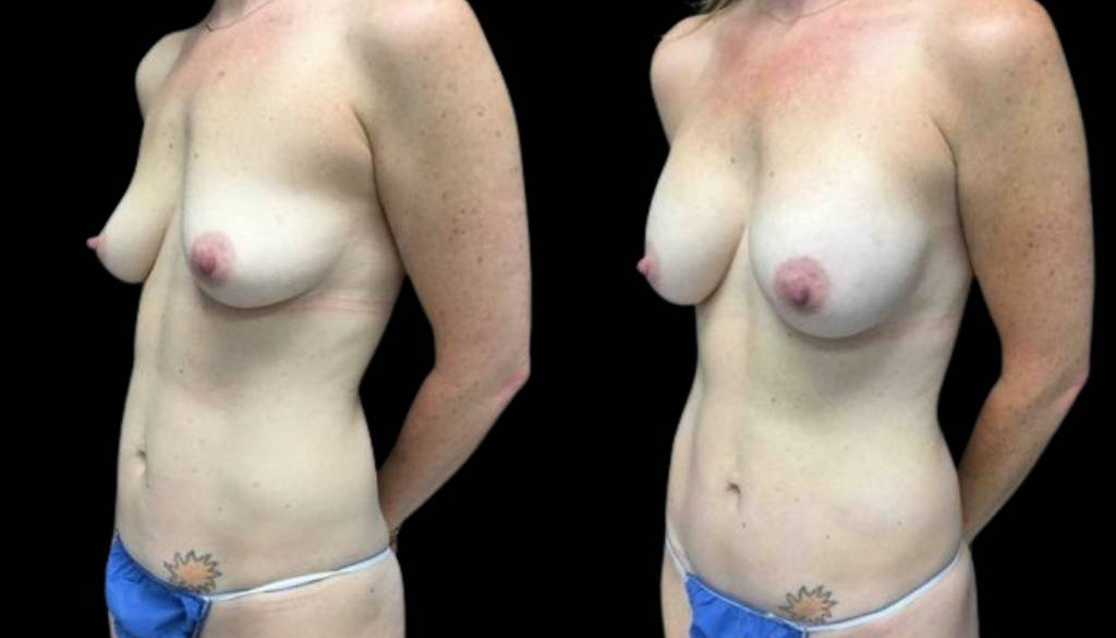 40-year-old-female-mommy-makeover-body-before-and-after-three-quarters-view-21536.jpg