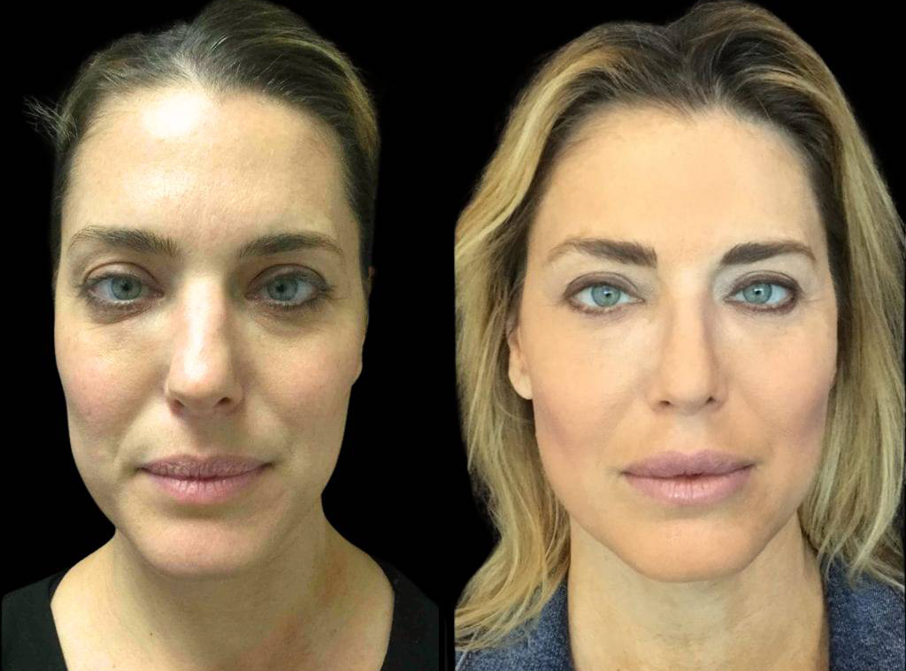 40-year-old-female-rhinoplasty-before-and-after-front-view-.jpg