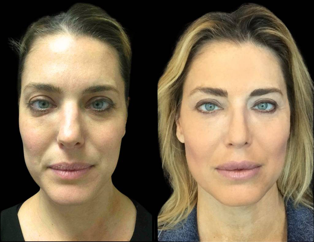 40-year-old-female-rhinoplasty-before-and-after-front-view-.jpg