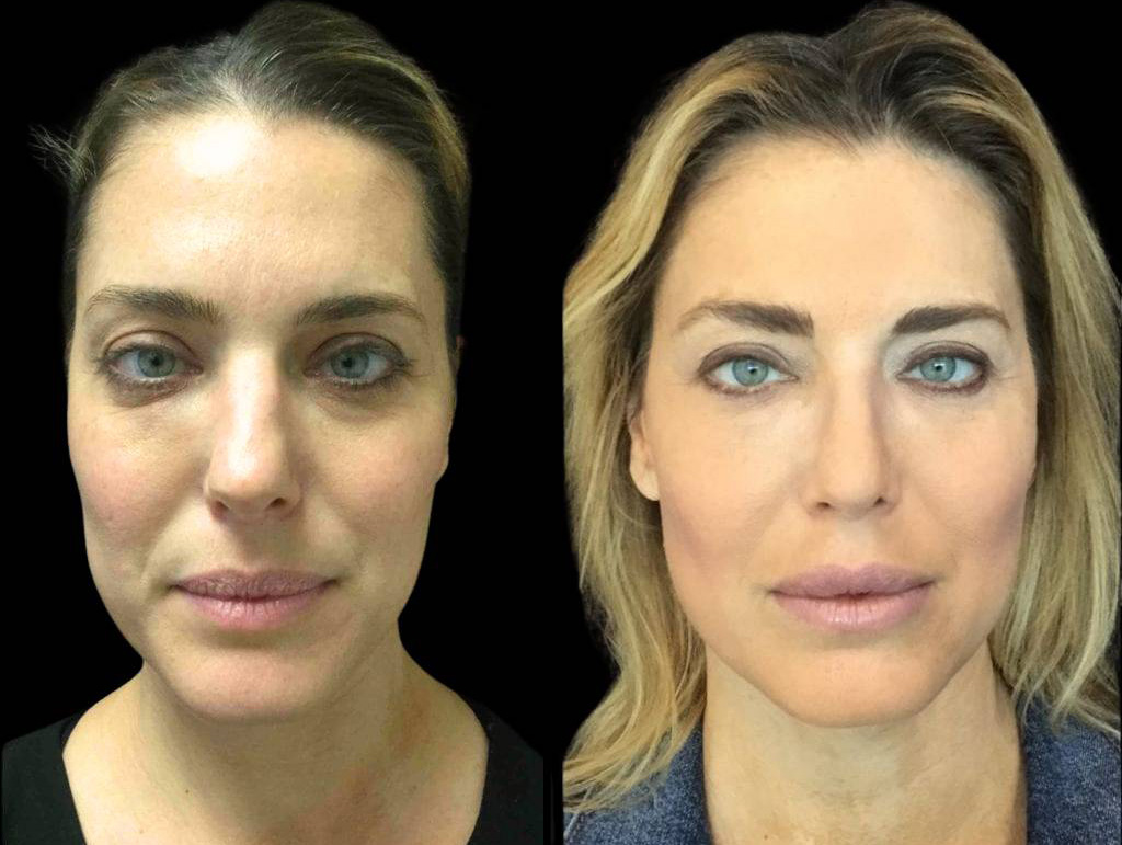 40-year-old-female-rhinoplasty-before-and-after-front-view-.jpg