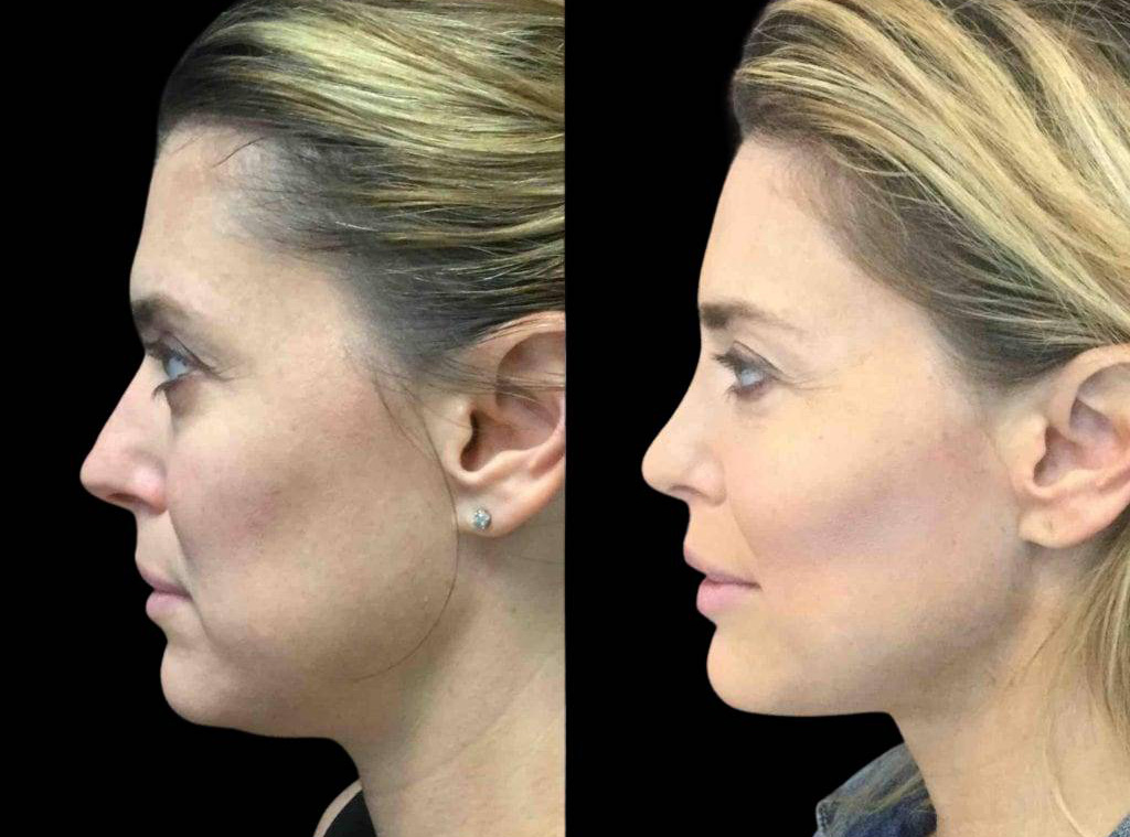 40-year-old-female-rhinoplasty-before-and-after-side-view-.jpg