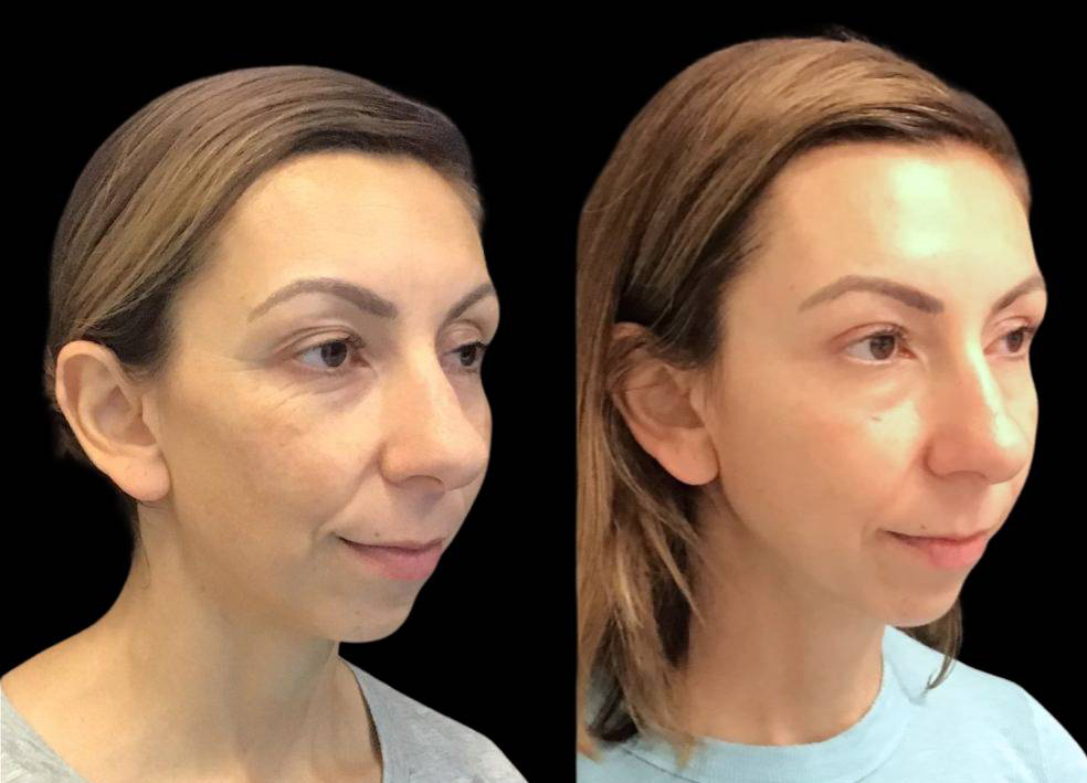 40-year-old-female-upper-eyelid-lift-before-and-after-three-quarters-view-.jpg