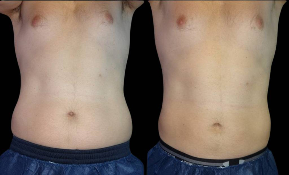 40-year-old-male-coolsculpting-before-and-after-front-view.jpg