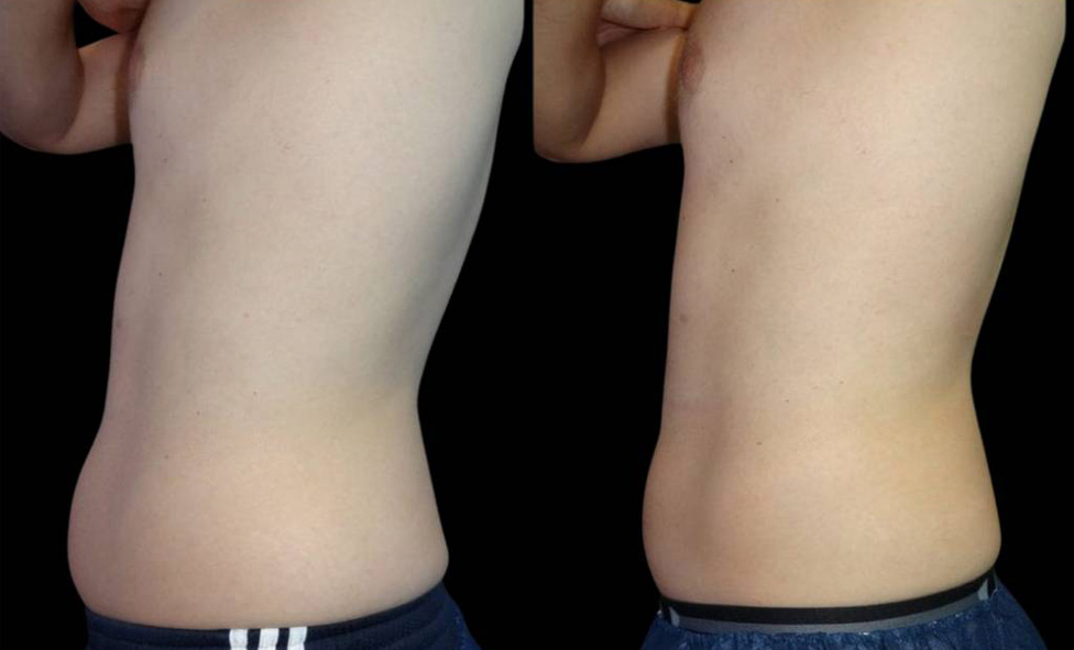 40-year-old-male-coolsculpting-before-and-after-side-view.jpg