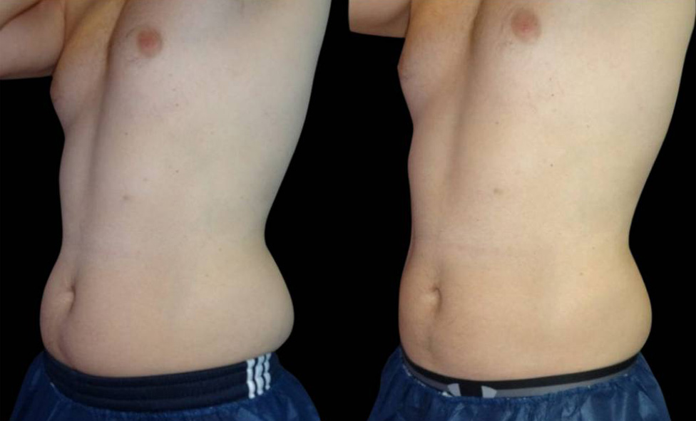 40-year-old-male-coolsculpting-before-and-after-three-quarters-view-17261.jpg
