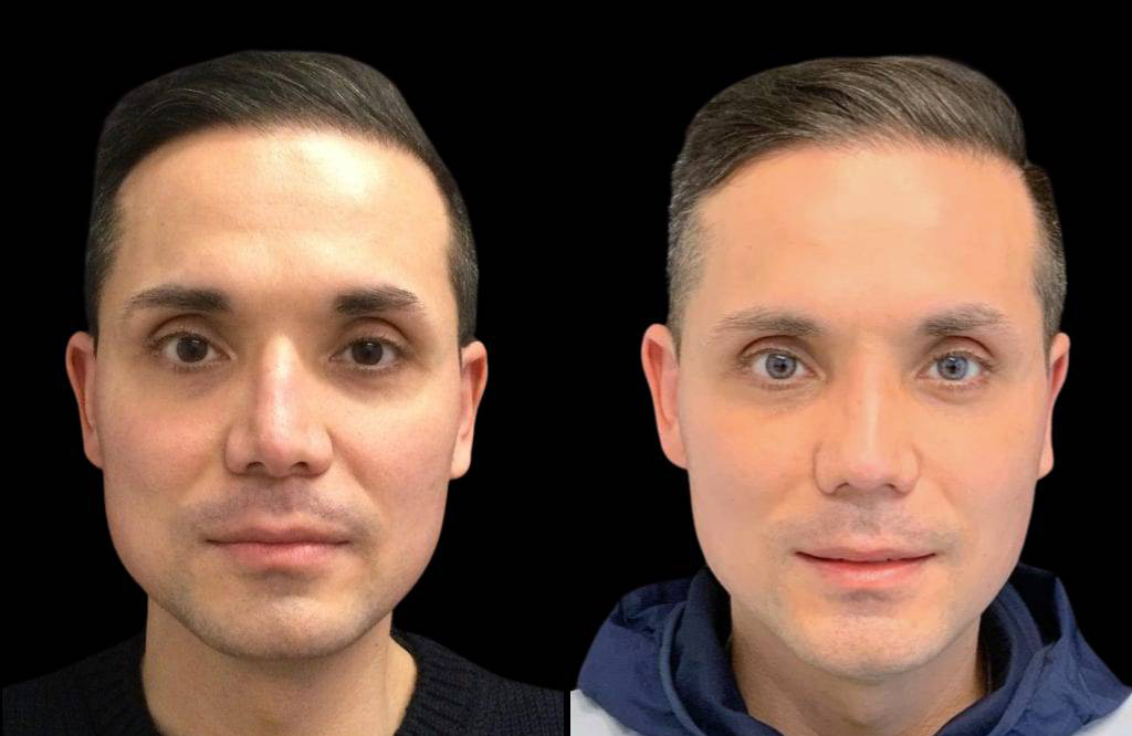 40-year-old-male-rhinoplasty-before-and-after-front-view.jpg