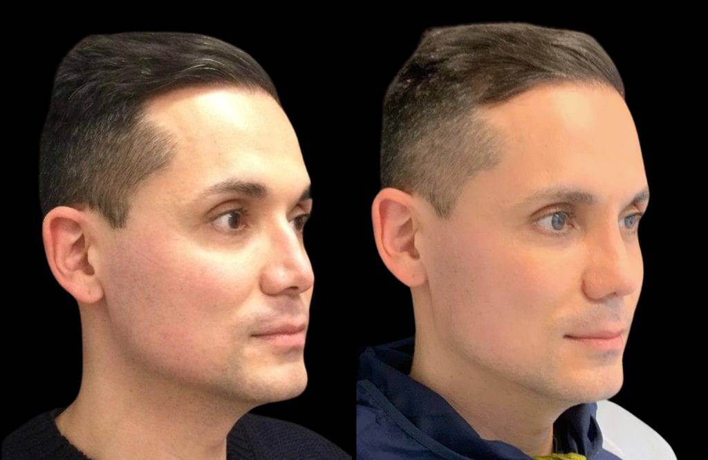 40-year-old-male-rhinoplasty-before-and-after-three-quarters-view.jpg