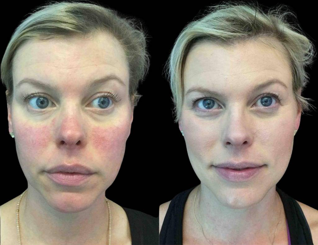 This is a 41-year-old female that has had BBL photo rejuvenation showing the before and after's side-by-side