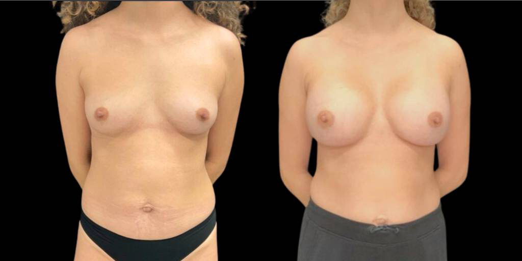 This is a 41-year-old female that has had a breast augmentation and implant showing the before and after's side-by-side