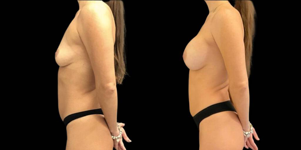 This is a 41-year-old female that has had a breast augmentation and implant showing the before and after's side-by-side