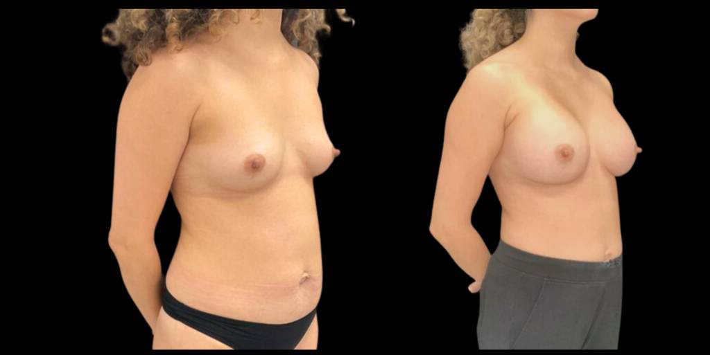 This is a 41-year-old female that has had a breast augmentation and implant showing the before and after's side-by-side