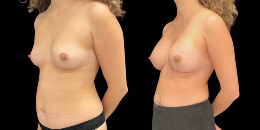This is a 41-year-old female that has had a breast augmentation and implant showing the before and after's side-by-side
