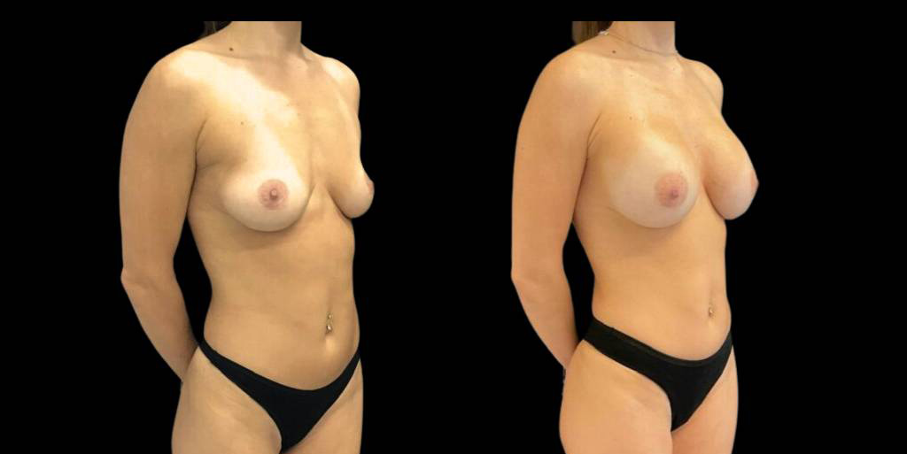 This is a 41-year-old female that has had a breast augmentation and implant showing the before and after's side-by-side