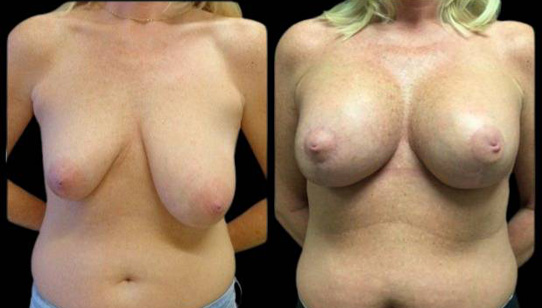 41-year-old-female-breast-lift-and-augmentation-before-and-after-front-view.jpg