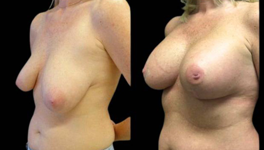 41-year-old-female-breast-lift-and-augmentation-before-and-after-three-quarter-view.jpg