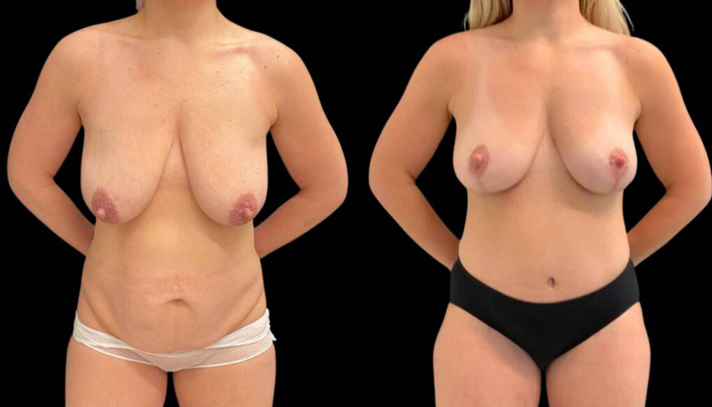 41-year-old-female-breast-lift-before-and-after-front-view-36620.jpg