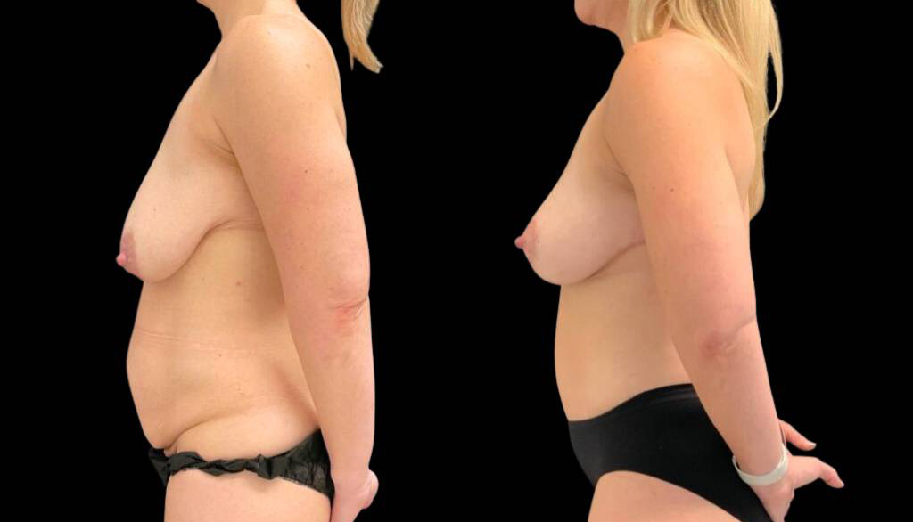 41-year-old-female-breast-lift-before-and-after-side-view.jpg