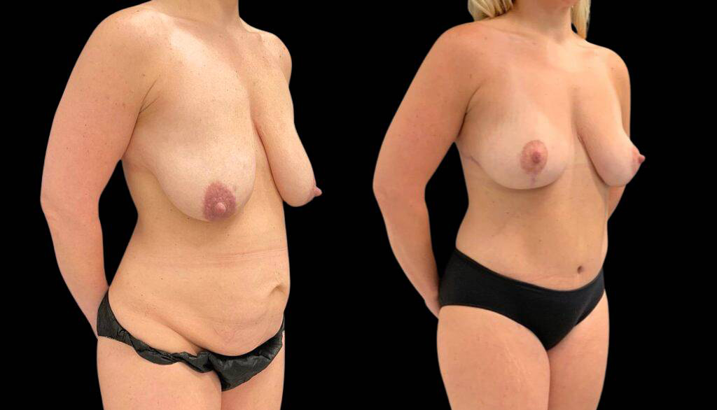 41-year-old-female-breast-lift-before-and-after-three-quarter-view-2.jpg